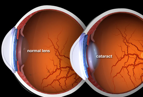 Diagram of eye anatomy showing how light passes through the lens to the retina during vision