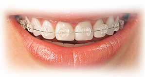 Patient holding transparent clear aligners for invisible orthodontic teeth straightening